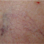 Laser vasculaire et varicosités caen